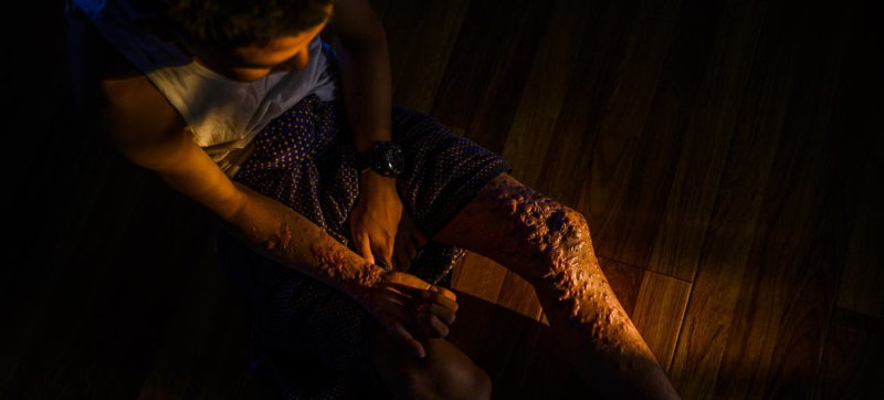 Мальчик из Мьянмы получил тяжелые травмы в результате подрыва на мине.